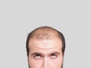 Why People Go For Hair Transplant?