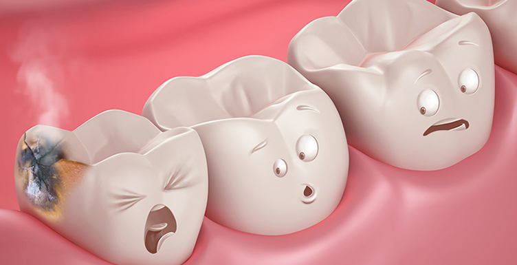 Six Interesting Facts and Myths about Tooth Cavities