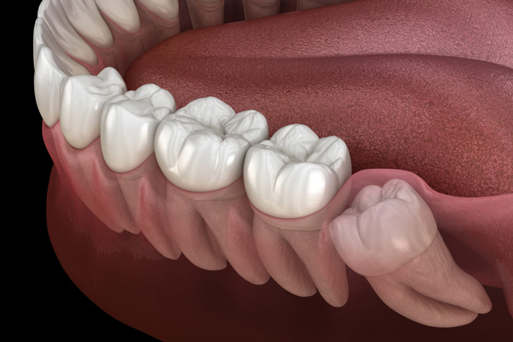 Wisdom Teeth Grow and Should You Remove
