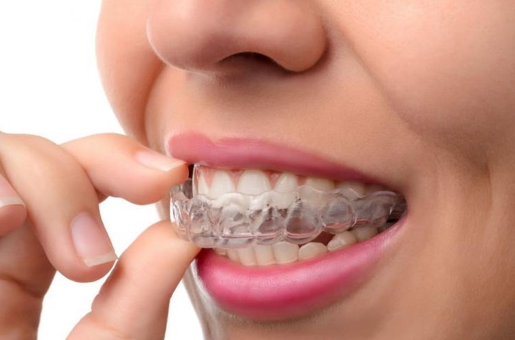 how to straighten teeth without braces