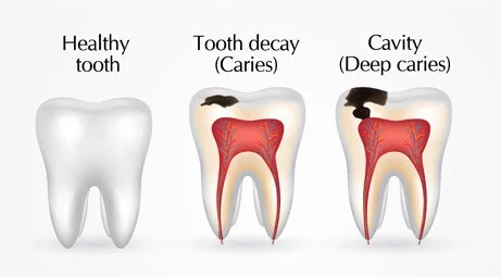 Cavity & Tooth Decay Difference