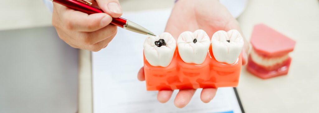 Cavity & Tooth Decay Difference