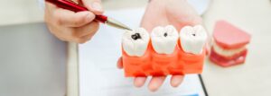 Cavity & Tooth Decay Difference