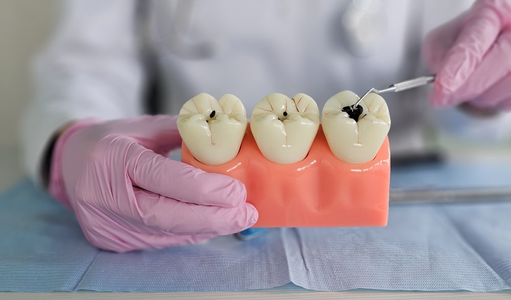 Cavity & Tooth Decay Difference