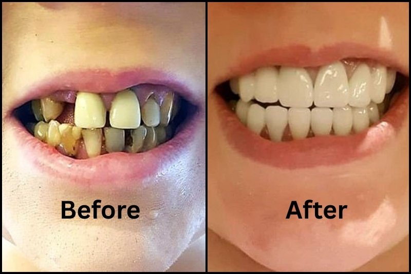 stop tooth from rotting