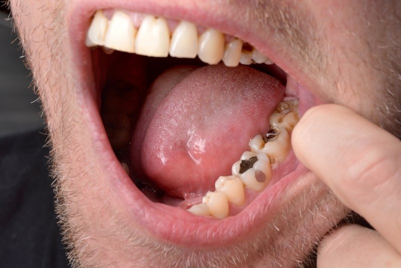 stop teeth from rotting2