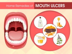 how to treat a mouth ulcer
