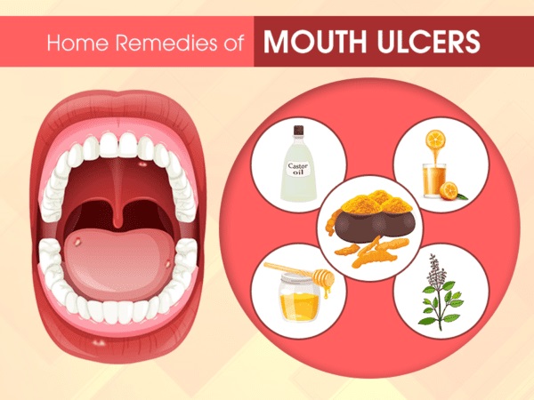 how to treat a mouth ulcer