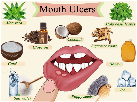 how to treat a mouth ulcer